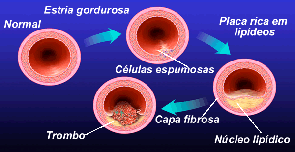 ateromas